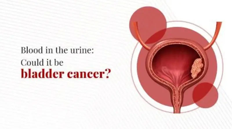 Bladder Cancer