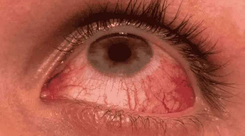 eye infection